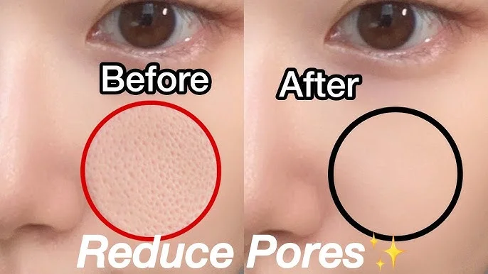 Side-by-side comparison of skin before and after pore reduction treatment, highlighting visible changes in pore size.